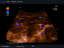 Ultrazvok ledvic - prirojena anomalija ledvic, podkvasta ledvica, ledvici sta povezani